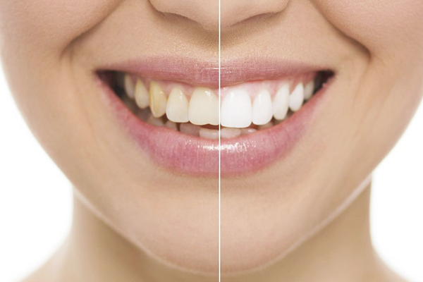 Teeth Whitening in North Edmonton